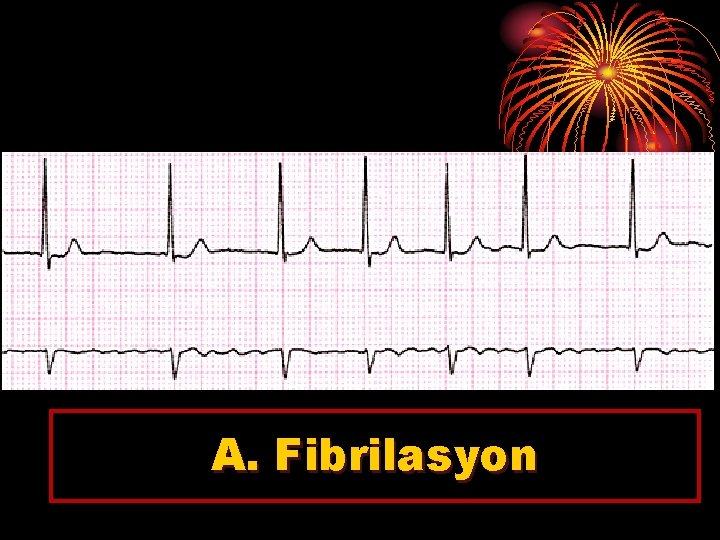 A. Fibrilasyon 