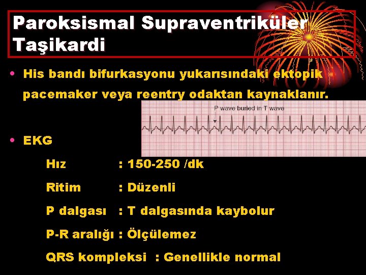 Paroksismal Supraventriküler Taşikardi • His bandı bifurkasyonu yukarısındaki ektopik pacemaker veya reentry odaktan kaynaklanır.