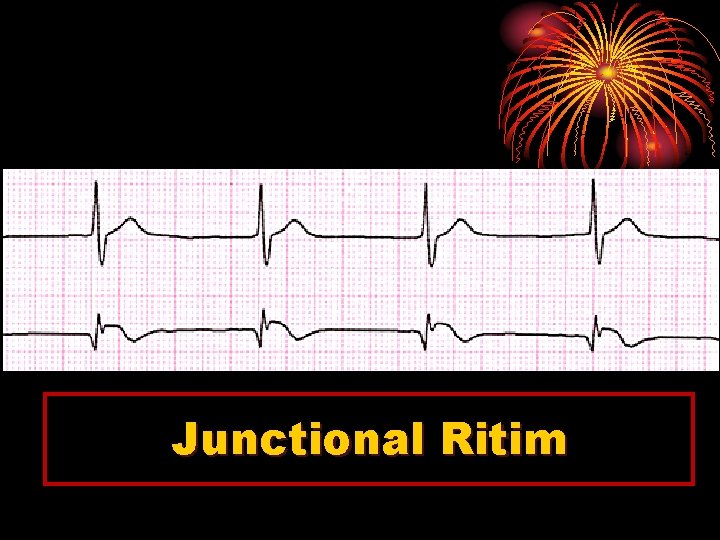 Junctional Ritim 