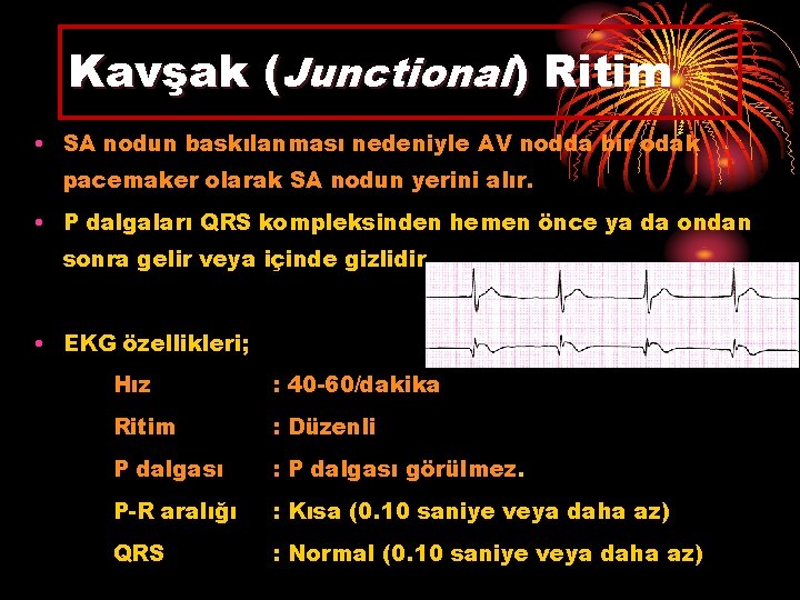 Kavşak (Junctional) Ritim • SA nodun baskılanması nedeniyle AV nodda bir odak pacemaker olarak