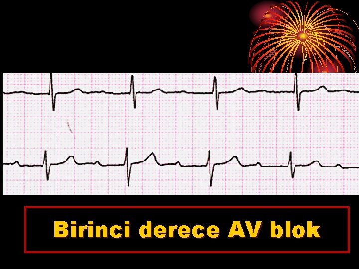 Birinci derece AV blok 