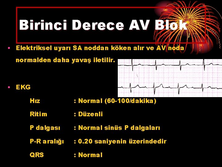 Birinci Derece AV Blok • Elektriksel uyarı SA noddan köken alır ve AV noda