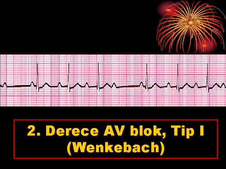 2. Derece AV blok, Tip I (Wenkebach) 