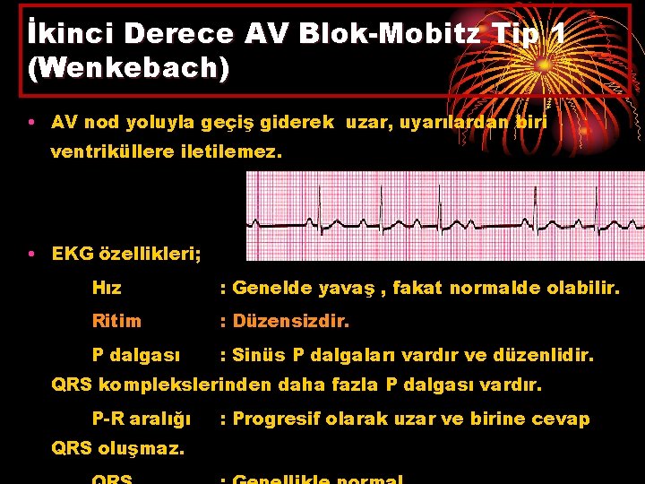 İkinci Derece AV Blok-Mobitz Tip 1 (Wenkebach) • AV nod yoluyla geçiş giderek uzar,