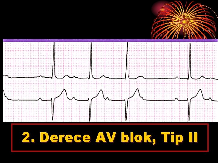 2. Derece AV blok, Tip II 