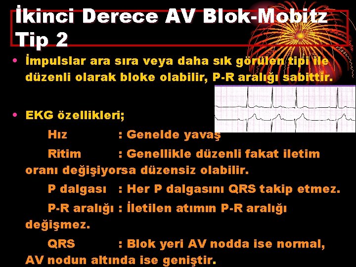 İkinci Derece AV Blok-Mobitz Tip 2 • İmpulslar ara sıra veya daha sık görülen