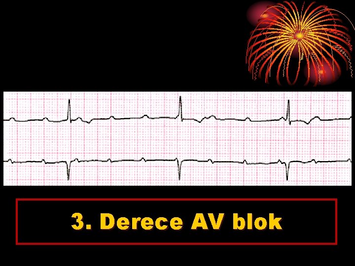 3. Derece AV blok 