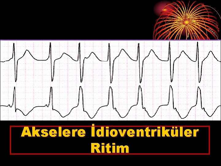 Akselere İdioventriküler Ritim 