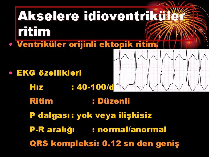 Akselere idioventriküler ritim • Ventriküler orijinli ektopik ritim. • EKG özellikleri Hız : 40