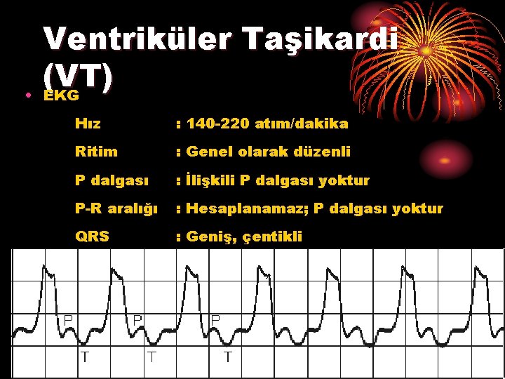  • Ventriküler Taşikardi (VT) EKG Hız : 140 -220 atım/dakika Ritim : Genel