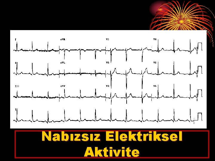 Nabızsız Elektriksel Aktivite 