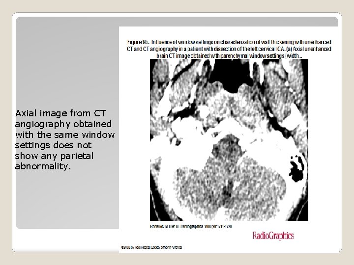 Axial image from CT angiography obtained with the same window settings does not show
