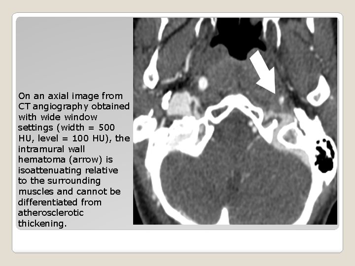 On an axial image from CT angiography obtained with wide window settings (width =