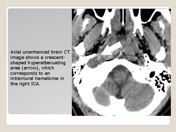 Axial unenhanced brain CT image shows a crescentshaped hyperattenuating area (arrow), which corresponds to