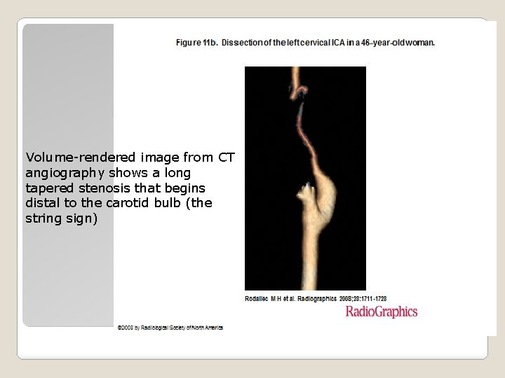 Volume-rendered image from CT angiography shows a long tapered stenosis that begins distal to