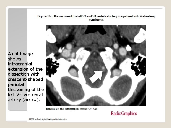 Axial image shows intracranial extension of the dissection with crescent-shaped parietal thickening of the