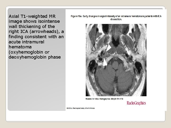 Axial T 1 -weighted MR image shows isointense wall thickening of the right ICA