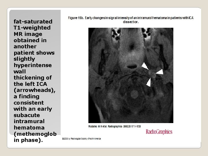 fat-saturated T 1 -weighted MR image obtained in another patient shows slightly hyperintense wall