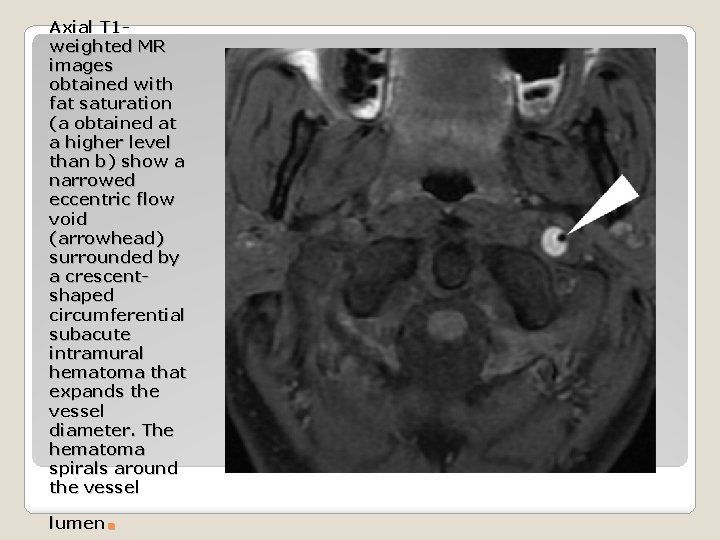 Axial T 1 weighted MR images obtained with fat saturation (a obtained at a