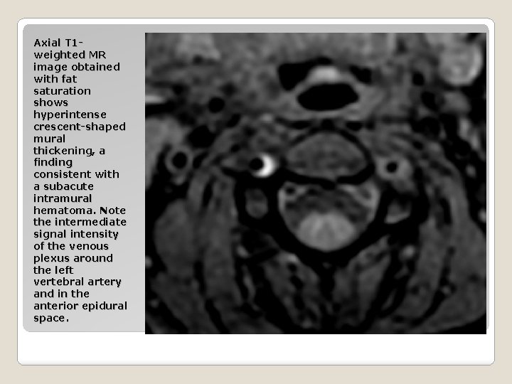 Axial T 1 weighted MR image obtained with fat saturation shows hyperintense crescent-shaped mural