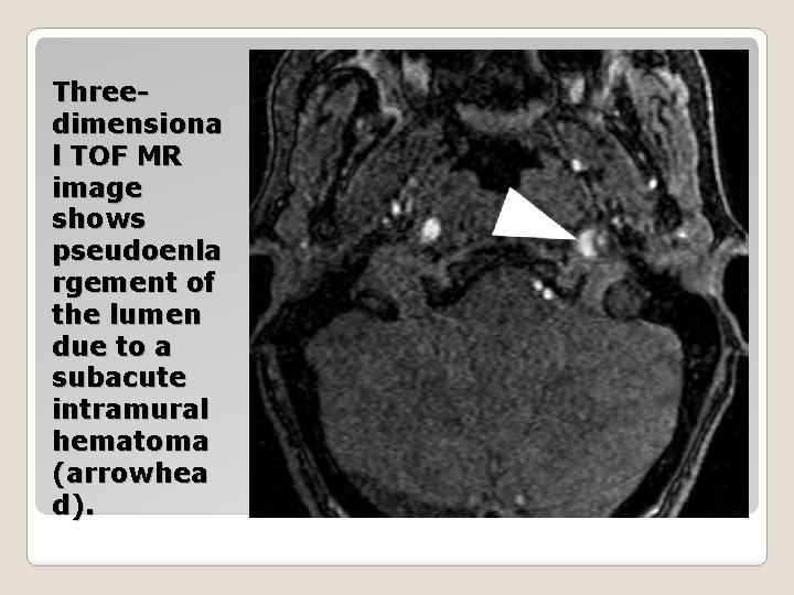Threedimensiona l TOF MR image shows pseudoenla rgement of the lumen due to a