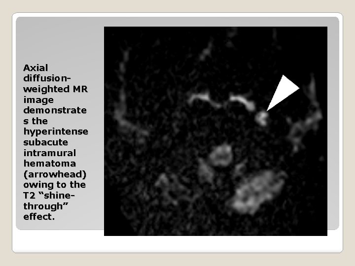 Axial diffusionweighted MR image demonstrate s the hyperintense subacute intramural hematoma (arrowhead) owing to