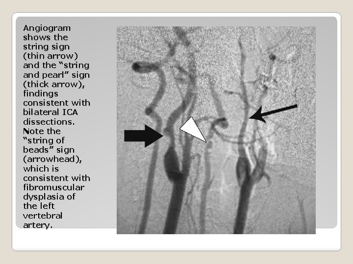 Angiogram shows the string sign (thin arrow) and the “string and pearl” sign (thick