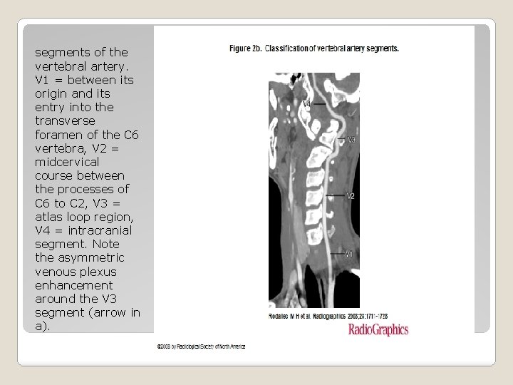 segments of the vertebral artery. V 1 = between its origin and its entry