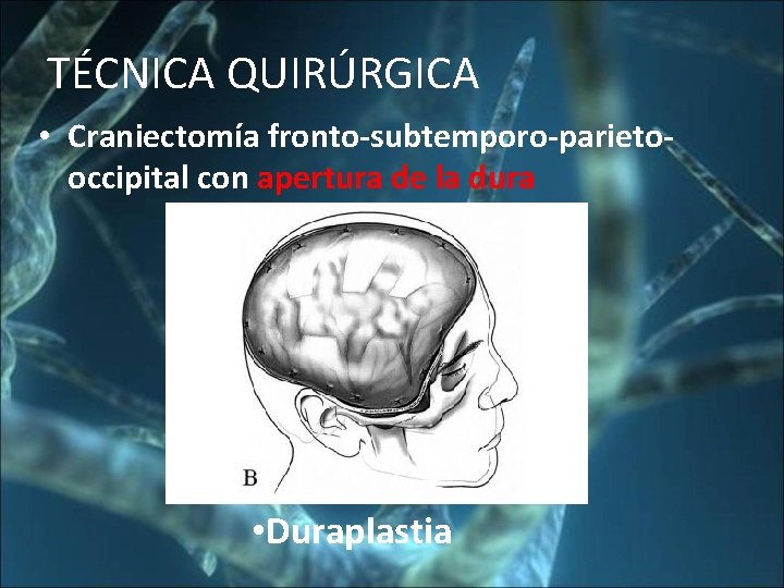 CRANEOTOMIA DESCOMPRESIVA EN EL PACIENTE NEUROCRTICO FISIOPATOLOGA DEL