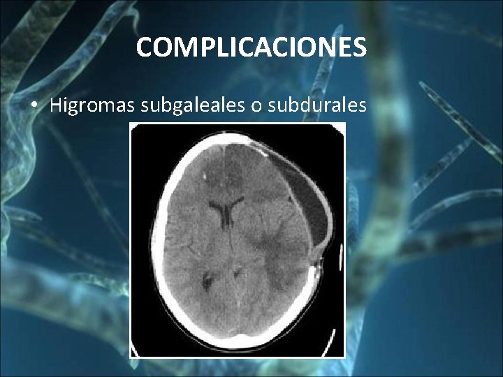 COMPLICACIONES • Higromas subgaleales o subdurales 