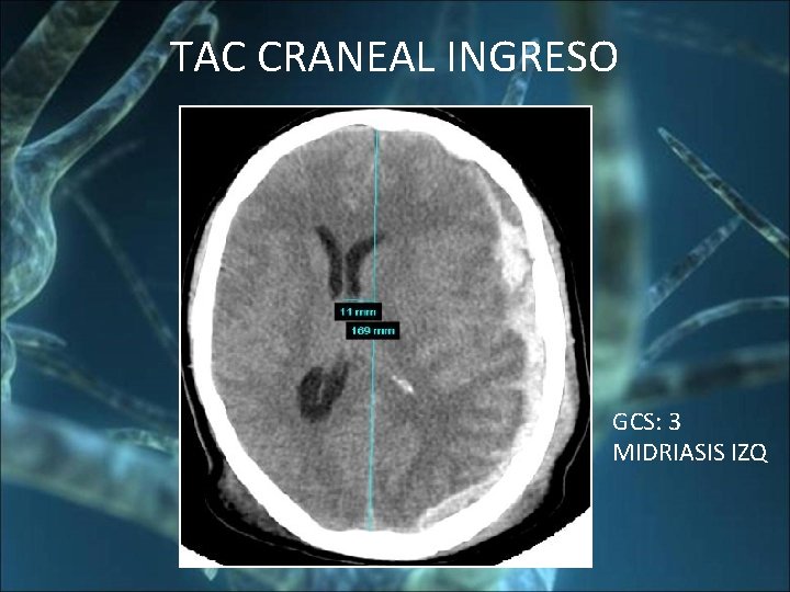 TAC CRANEAL INGRESO GCS: 3 MIDRIASIS IZQ 