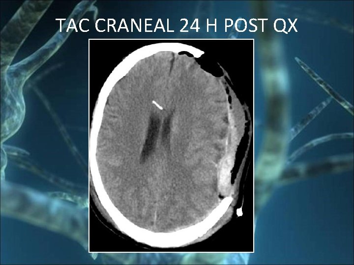 TAC CRANEAL 24 H POST QX 