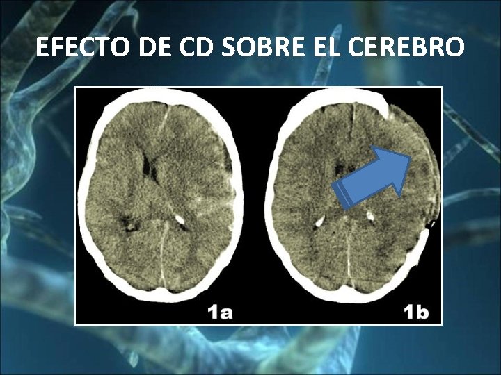EFECTO DE CD SOBRE EL CEREBRO 