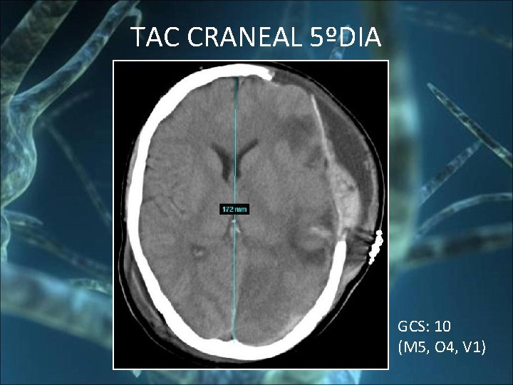 TAC CRANEAL 5ºDIA GCS: 10 (M 5, O 4, V 1) 