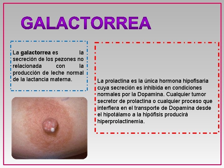 La galactorrea es la secreción de los pezones no relacionada con la producción de