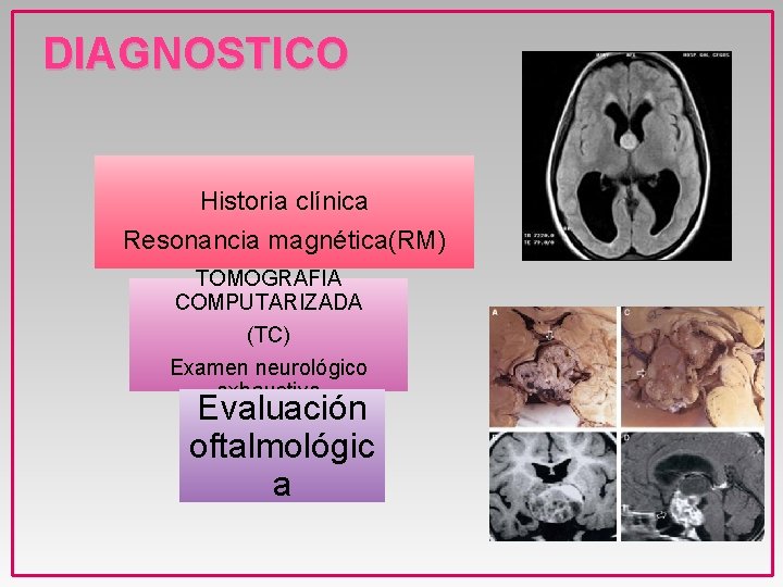 DIAGNOSTICO Historia clínica Resonancia magnética(RM) TOMOGRAFIA COMPUTARIZADA (TC) Examen neurológico exhaustivo Evaluación oftalmológic a