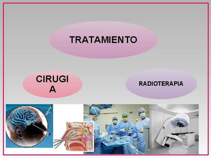 TRATAMIENTO CIRUGI A RADIOTERAPIA 