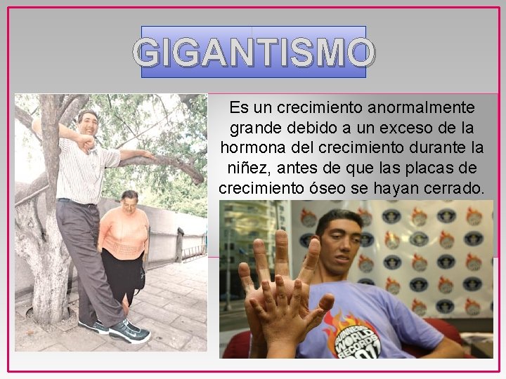 GIGANTISMO Es un crecimiento anormalmente grande debido a un exceso de la hormona del