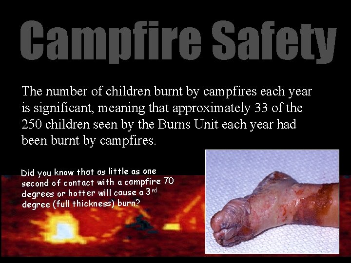 Campfire Safety The number of children burnt by campfires each year is significant, meaning