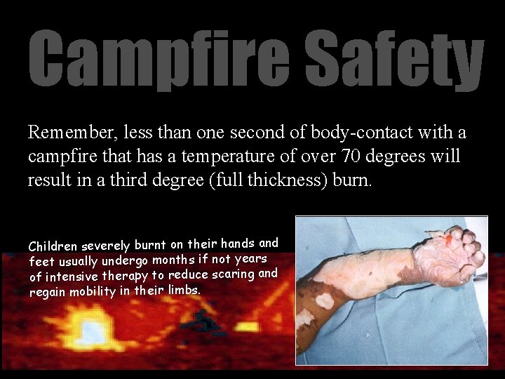 Campfire Safety Remember, less than one second of body-contact with a campfire that has