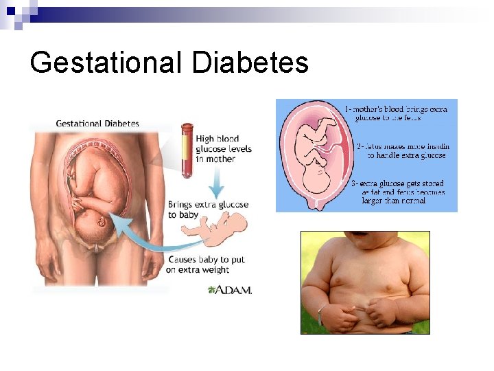 Gestational Diabetes 