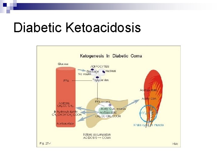 Diabetic Ketoacidosis 