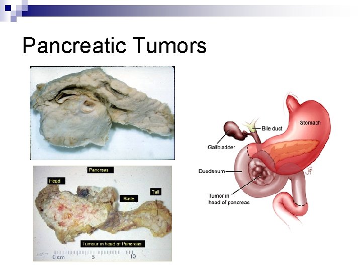 Pancreatic Tumors 