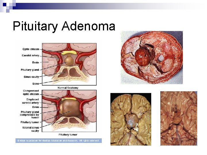 Pituitary Adenoma 