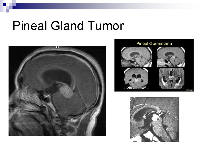 Pineal Gland Tumor 