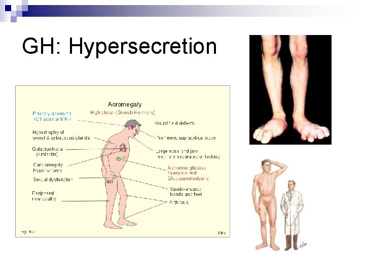 GH: Hypersecretion 