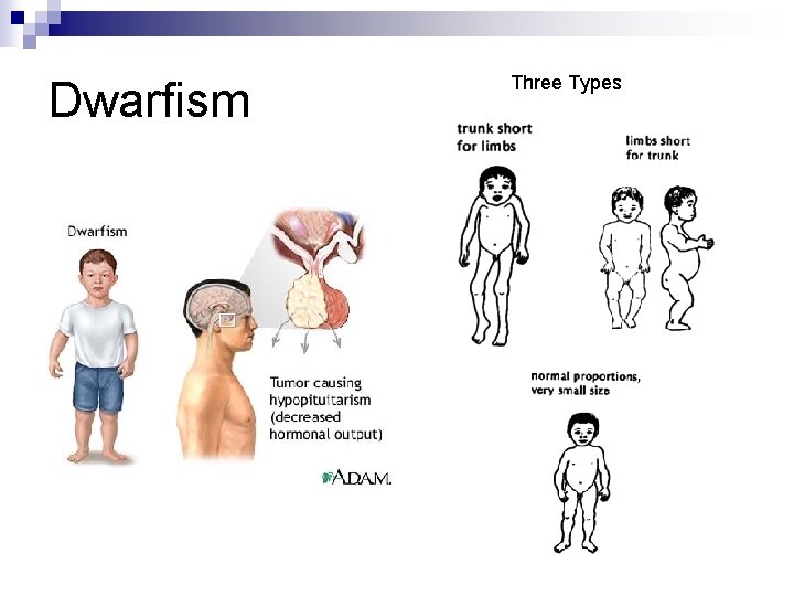 Dwarfism Three Types 