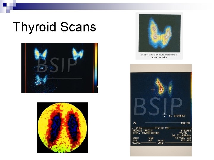 Thyroid Scans 