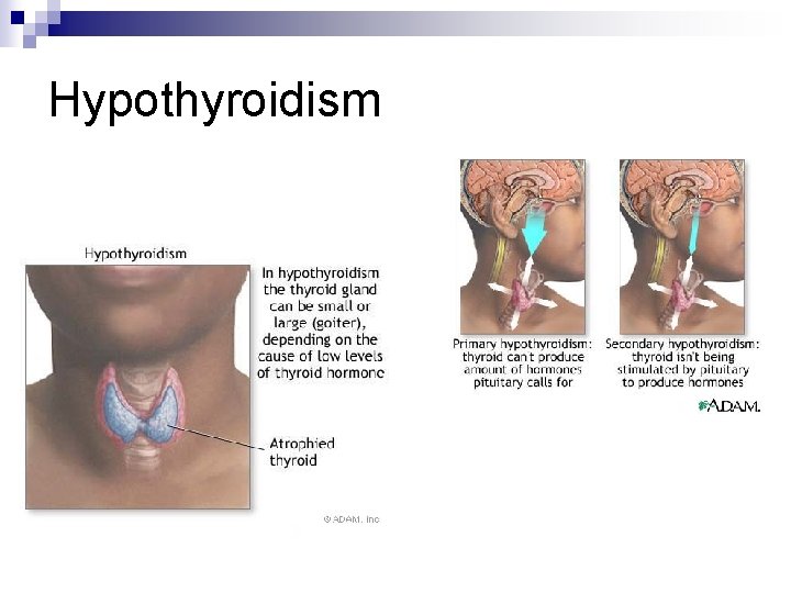 Hypothyroidism 