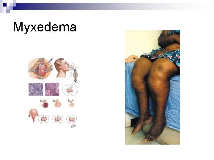 Myxedema 